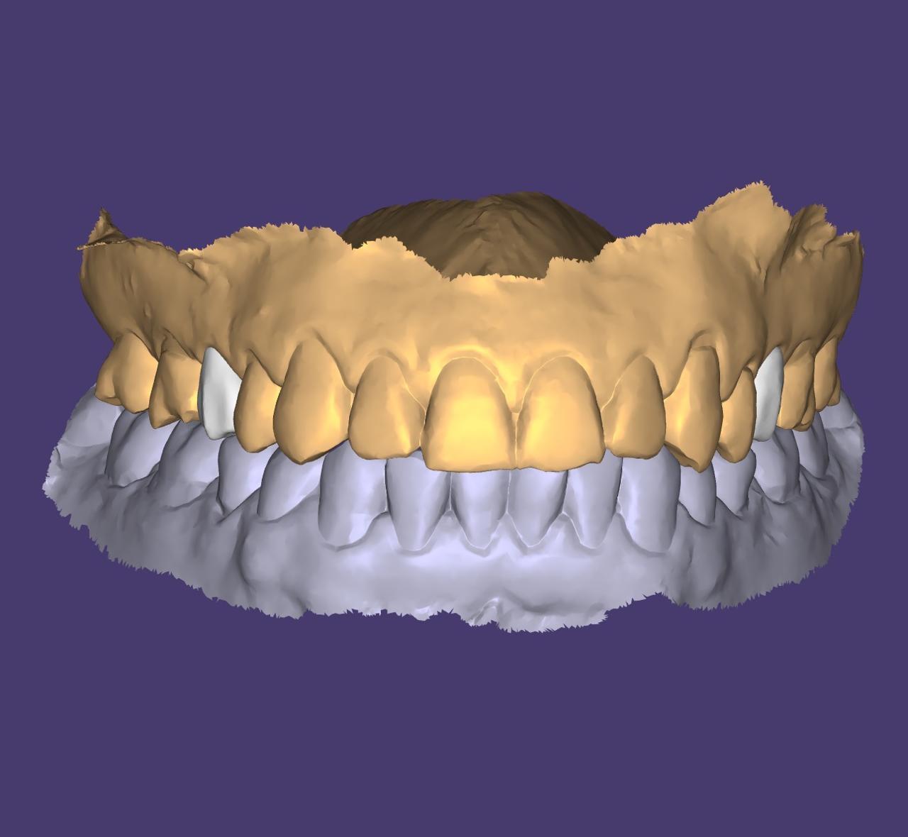 3D Smile Design 1