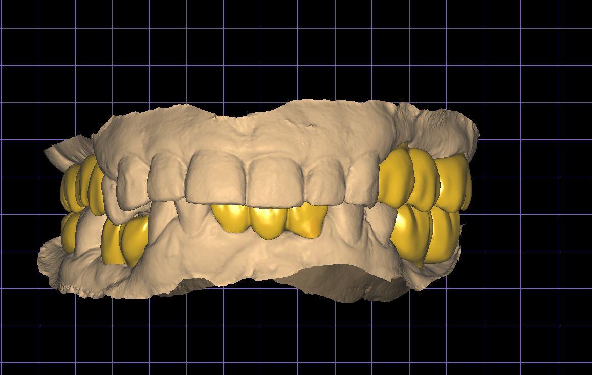 3D Smile Design 3