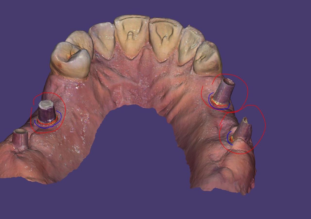 3D Smile Design 4