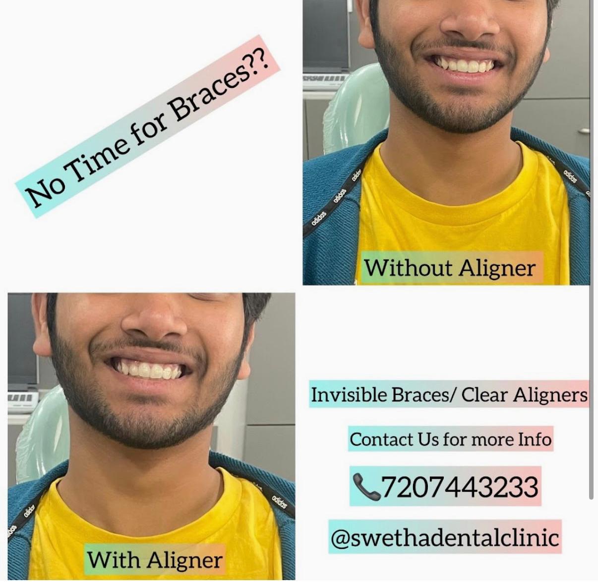 Clear Aligner 1