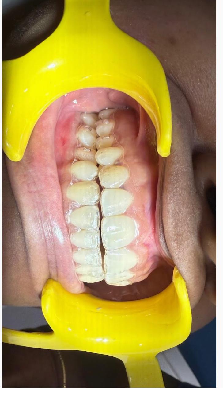 Clear Aligner 2