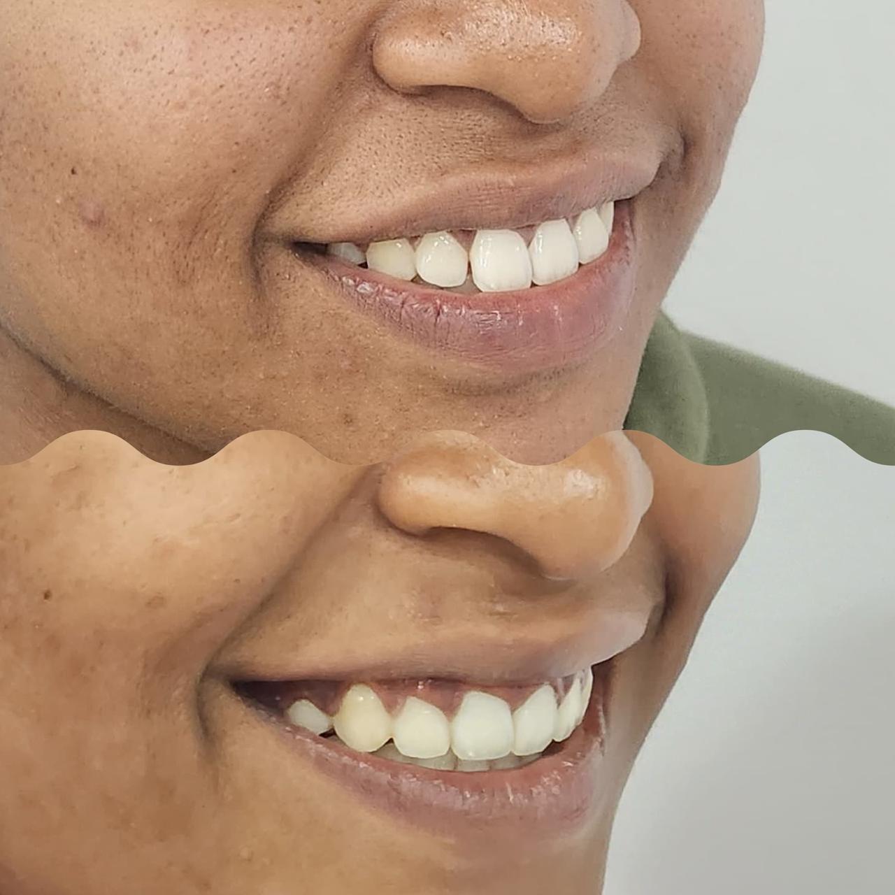 Clear Aligner 4