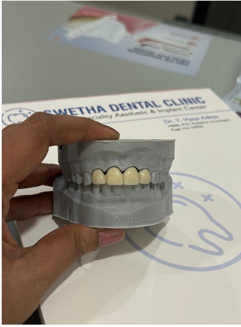 Dental Crown 1