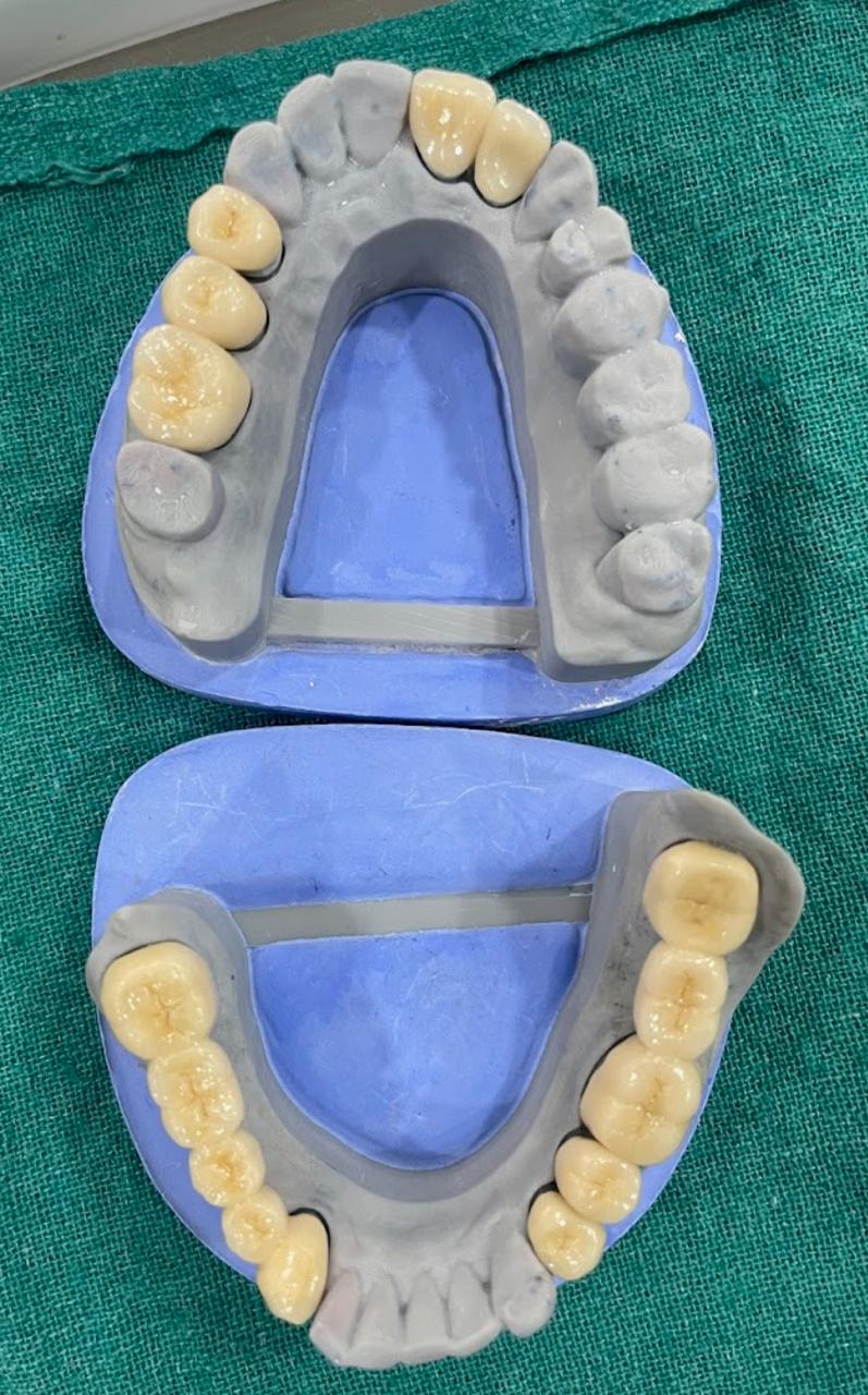 Dental Crown 2