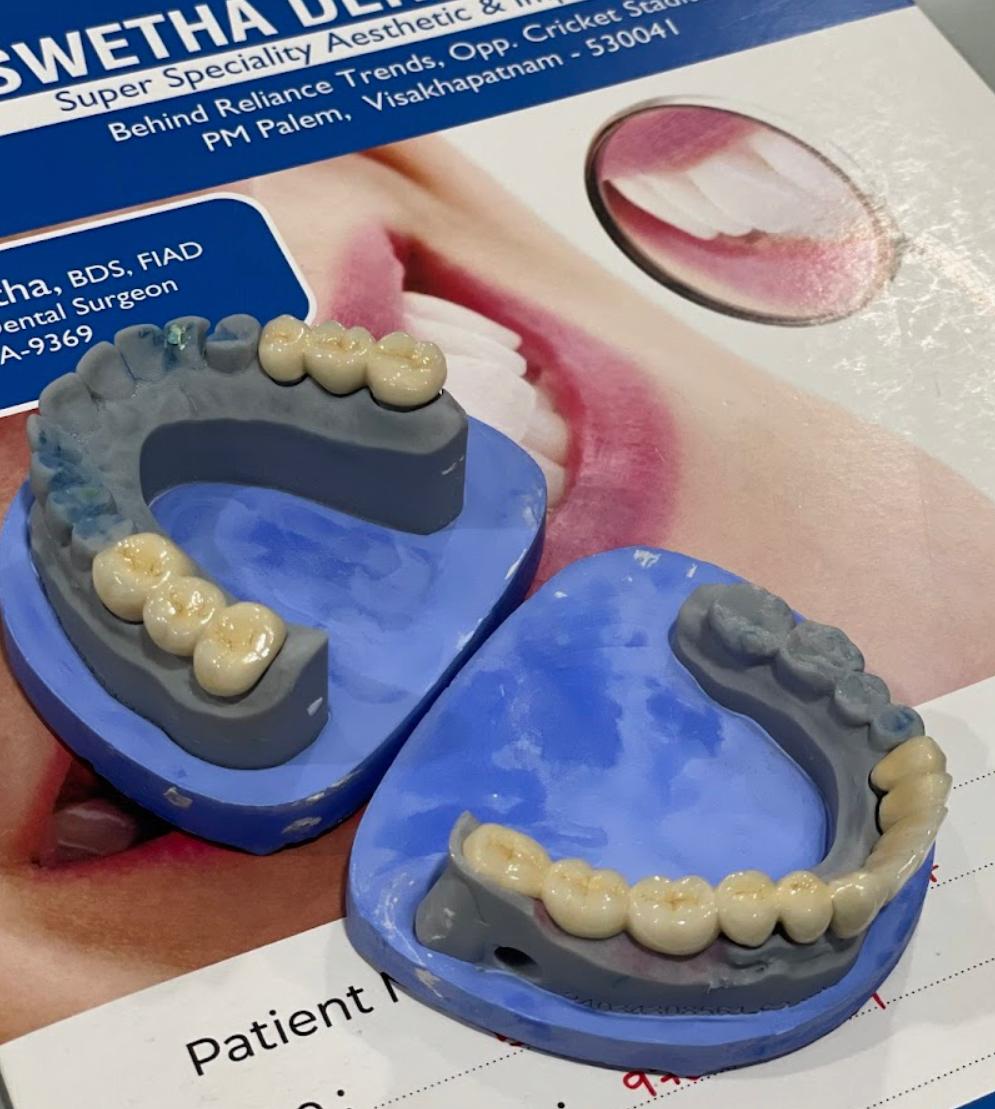 Dental Crown 3