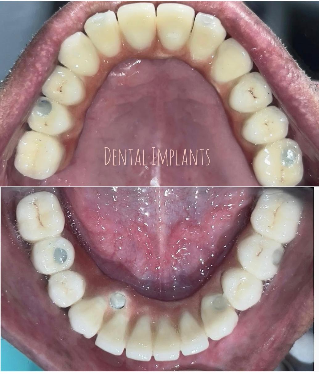 Dental Implant 1