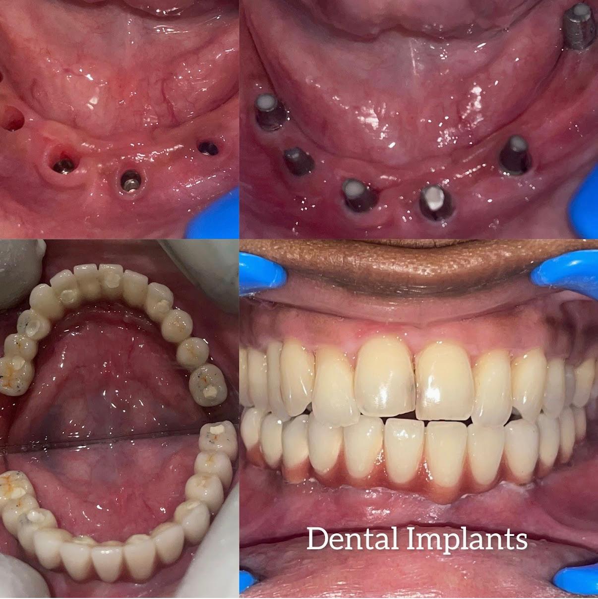 Dental Implant 2