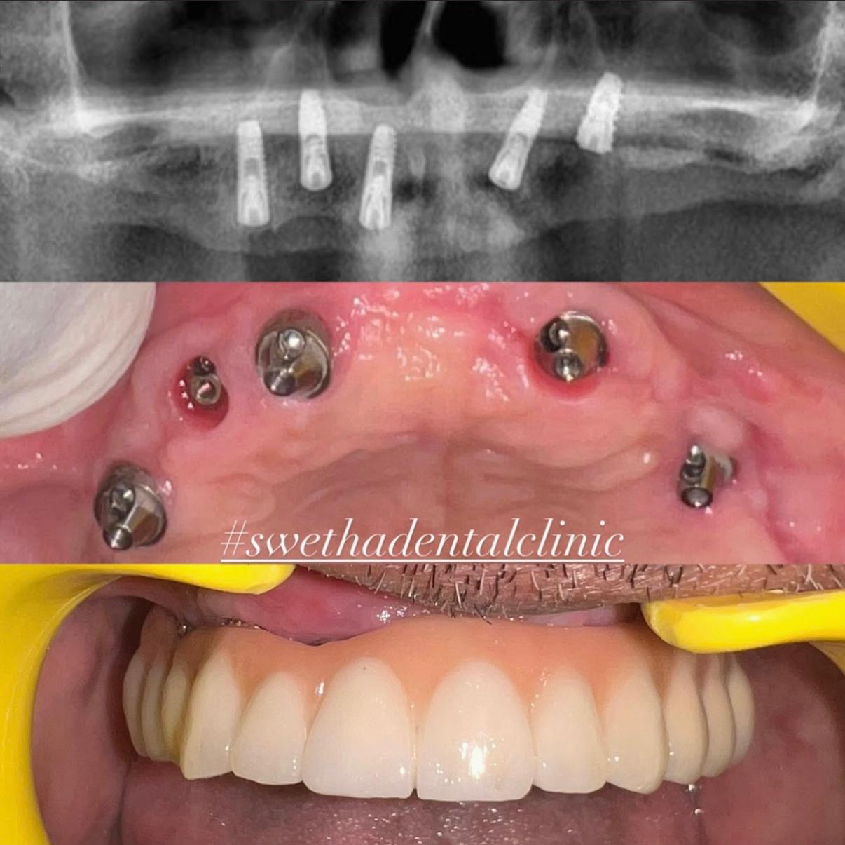 Dental Implant 3