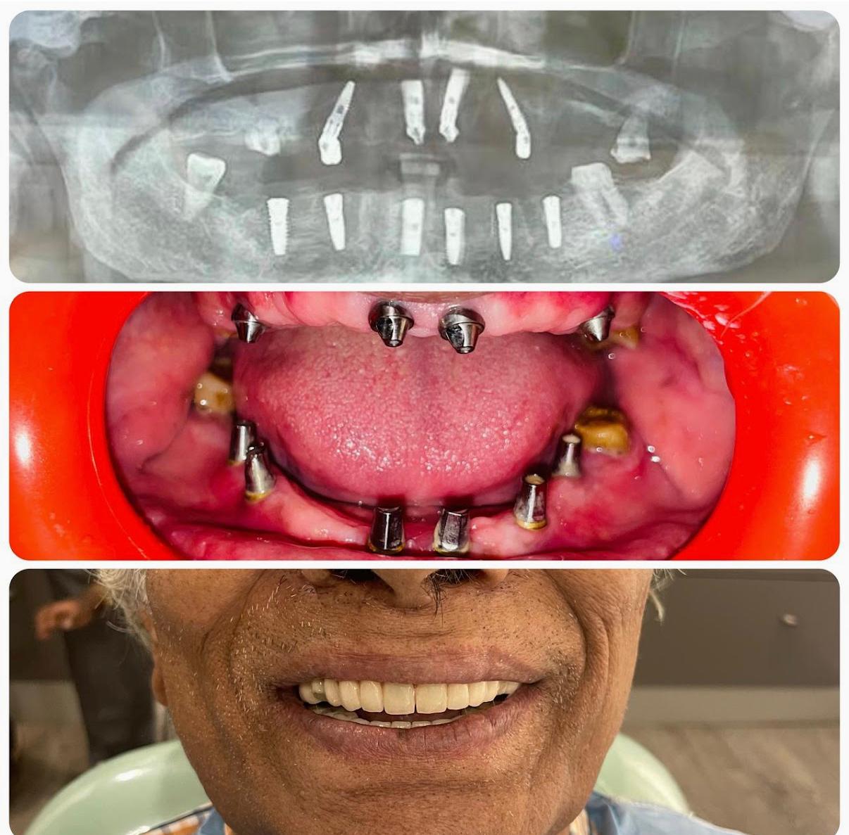 Dental Implant 4