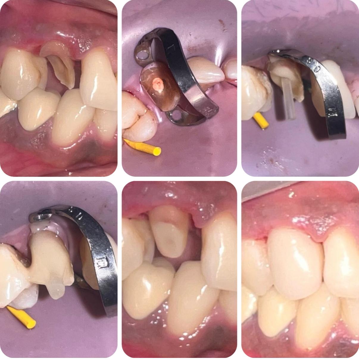 Root Canal Treatment 1