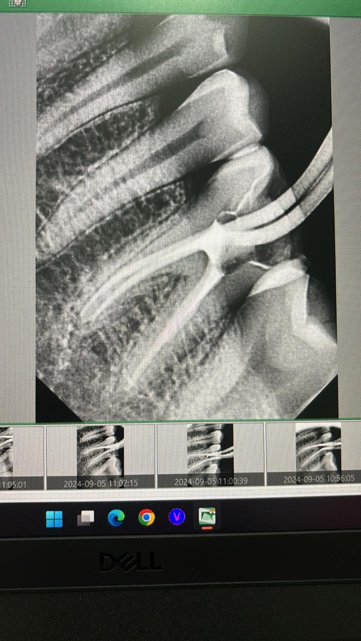 Root Canal Treatment 2