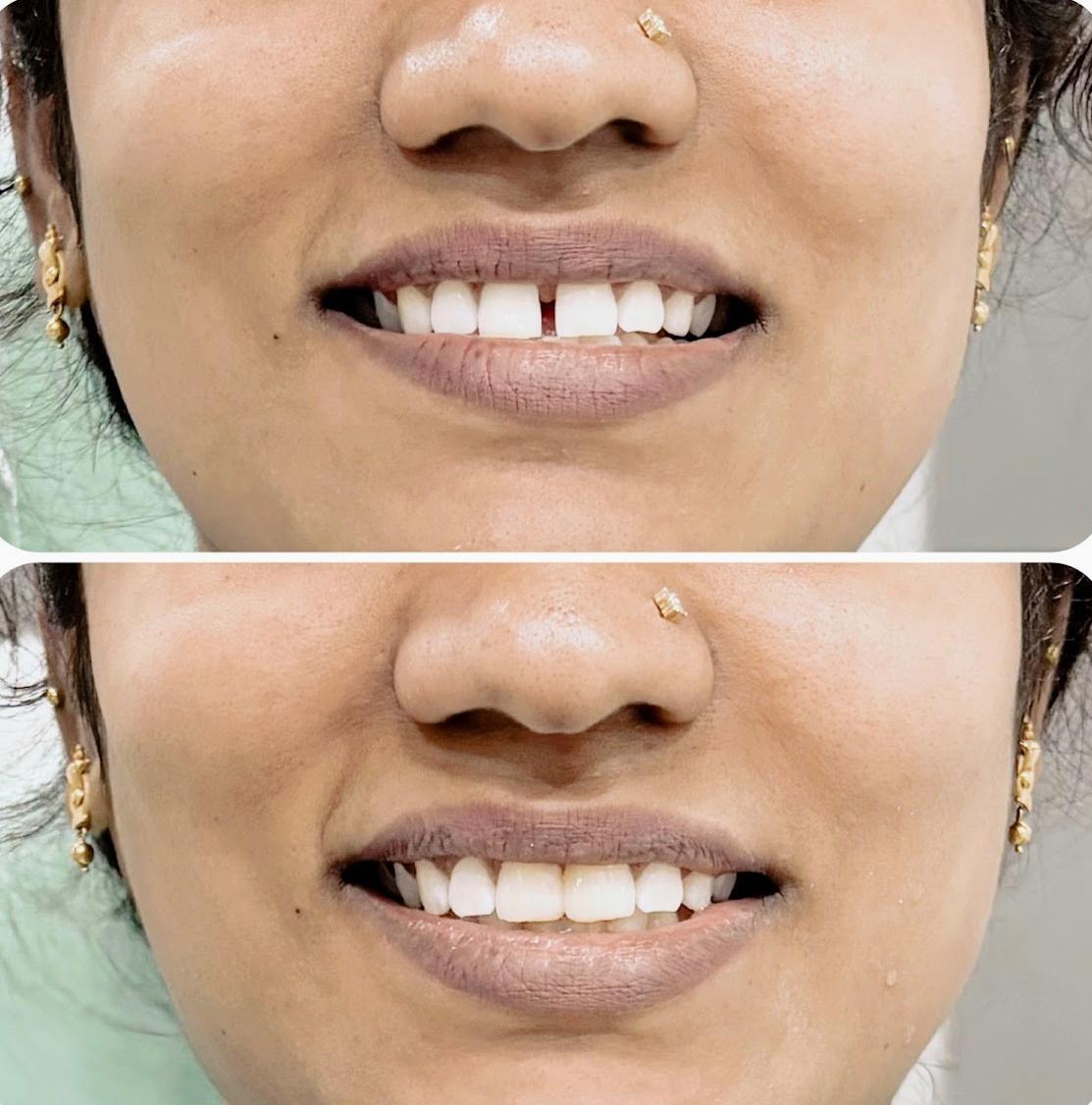Smile Designing 2