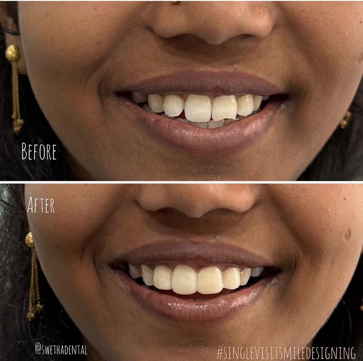 Smile Designing 3