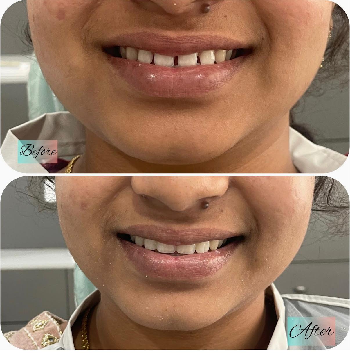 Smile Designing 4