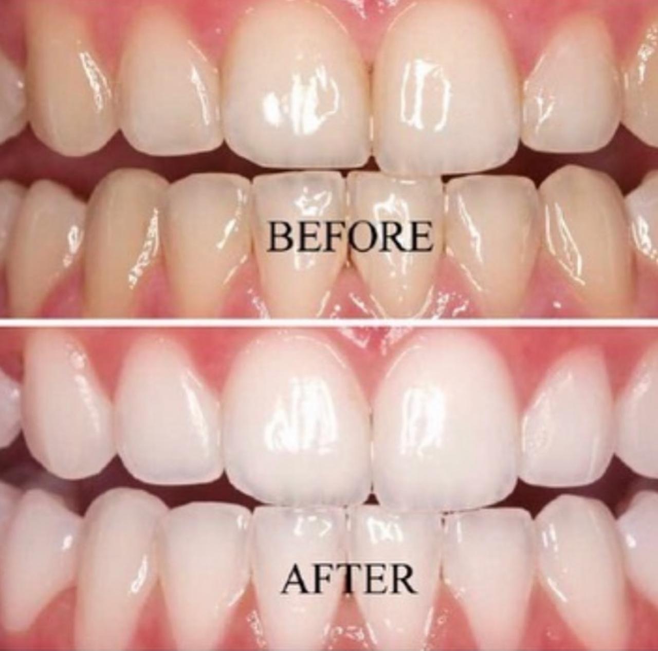 Teeth Whitening 1