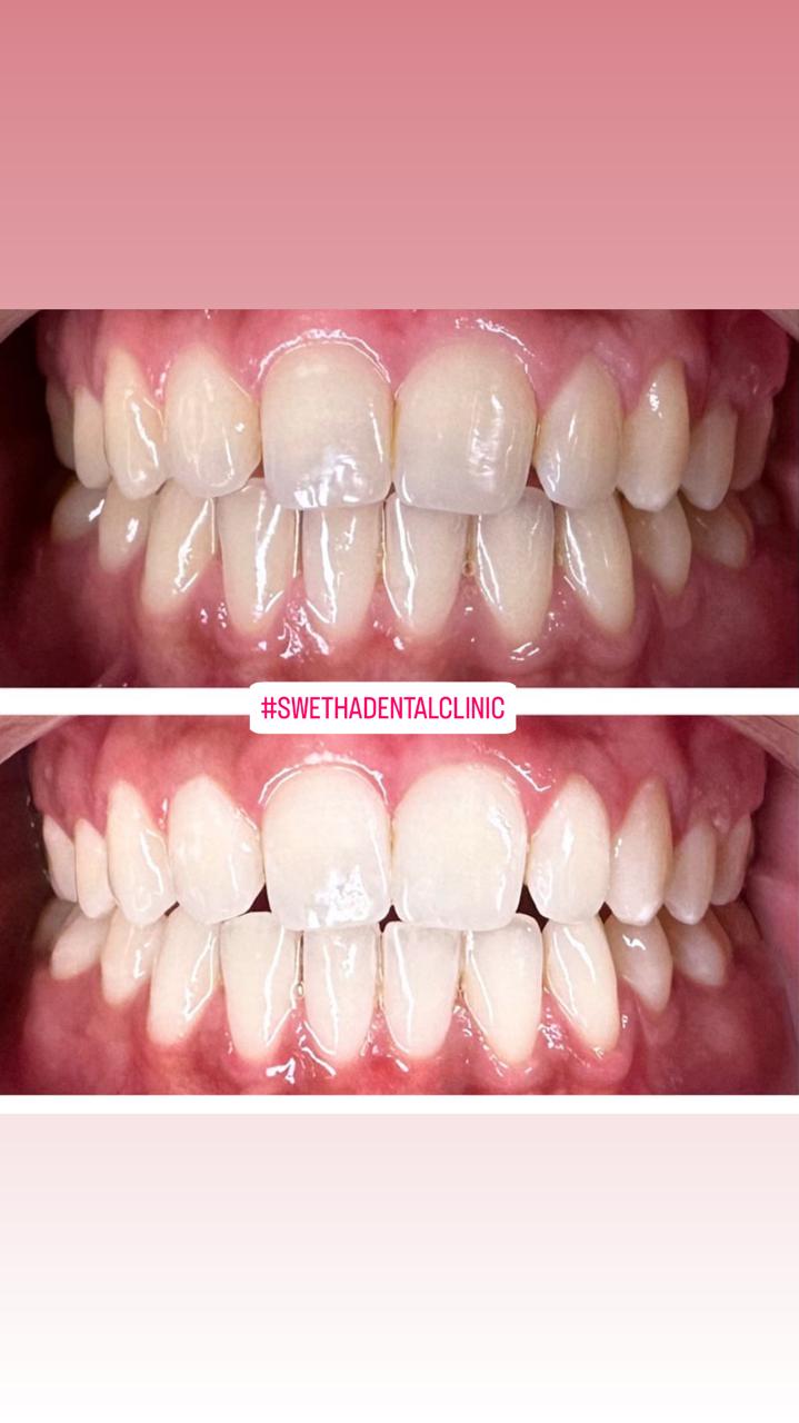 Teeth Whitening 2